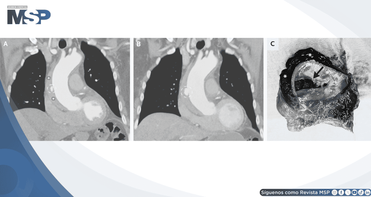 Dolor torácico pleurítico como presentación de hematoma intramural y disección de aorta ascendente Dolor torácico pleurítico como presentación de hematoma intramural y disección de aorta ascendente