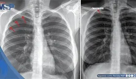 Punci&oacute;n seca provoc&oacute; colapso pulmonar por perforaci&oacute;n accidental de la pleura en paciente