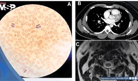 Uso indebido de óxido nitroso o "gas de la risa" provoca tromboembolismo pulmonar en hombres jóvenes
