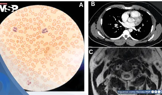 Uso indebido de &oacute;xido nitroso o "gas de la risa" provoca tromboembolismo pulmonar en hombres j&oacute;venes