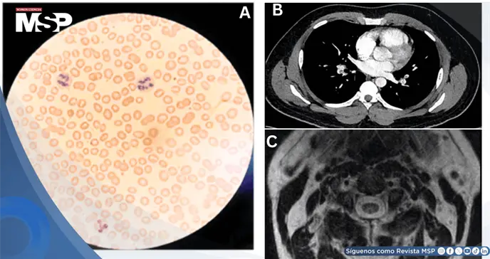 Uso indebido de óxido nitroso o "gas de la risa" provoca tromboembolismo pulmonar en hombres jóvenes Uso indebido de óxido nitroso o "gas de la risa" provoca tromboembolismo pulmonar en hombres jóvenes