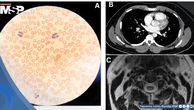 Uso indebido de óxido nitroso o "gas de la risa" provoca tromboembolismo pulmonar en hombres jóvenes Uso indebido de óxido nitroso o "gas de la risa" provoca tromboembolismo pulmonar en hombres jóvenes