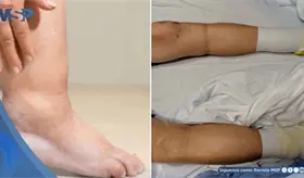 Paciente desarrolla cetoacidosis diabética asociada a edema insulínico tras interrupción de tratamiento