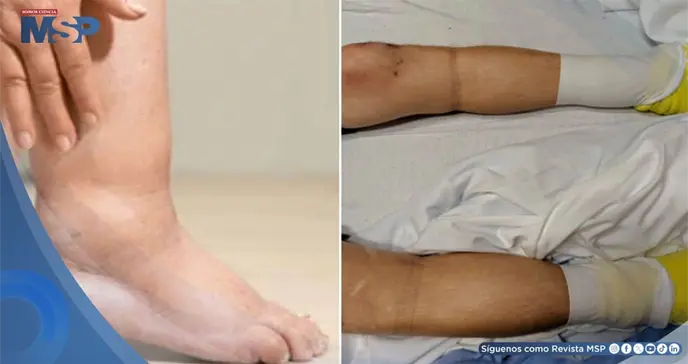 Paciente desarrolla cetoacidosis diab&eacute;tica asociada a edema insul&iacute;nico tras interrupci&oacute;n de tratamiento