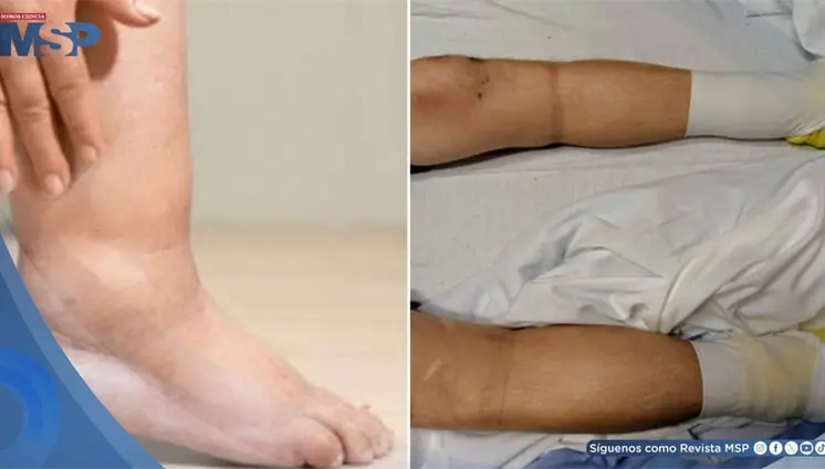 Paciente desarrolla cetoacidosis diab&eacute;tica asociada a edema insul&iacute;nico tras interrupci&oacute;n de tratamiento
