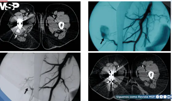 Pseudoaneurisma de arteria femoral profunda causa dolor inguinal tras cirug&iacute;a de artroplastia de cadera