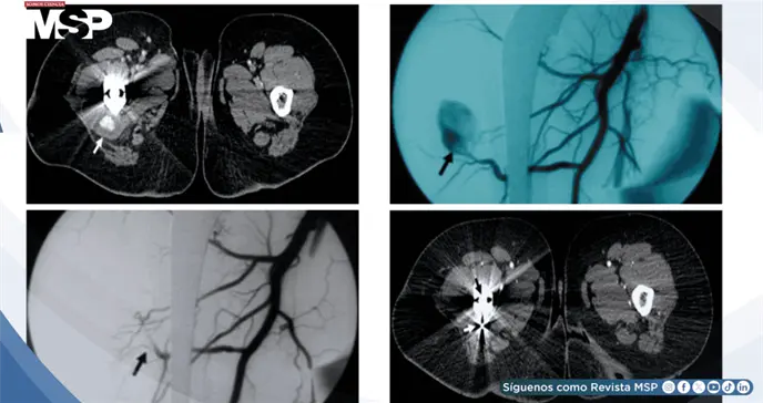 Pseudoaneurisma de arteria femoral profunda causa dolor inguinal tras cirugía de artroplastia de cadera Pseudoaneurisma de arteria femoral profunda causa dolor inguinal tras cirugía de artroplastia de cadera