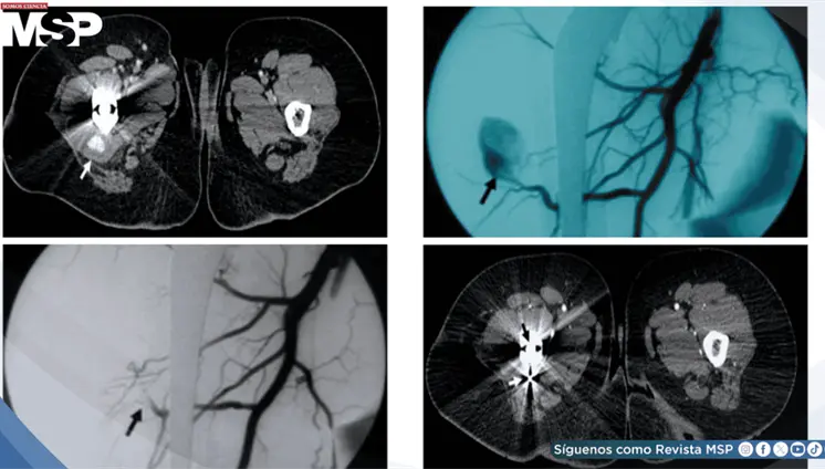 Pseudoaneurisma de arteria femoral profunda causa dolor inguinal tras cirugía de artroplastia de cadera Pseudoaneurisma de arteria femoral profunda causa dolor inguinal tras cirugía de artroplastia de cadera
