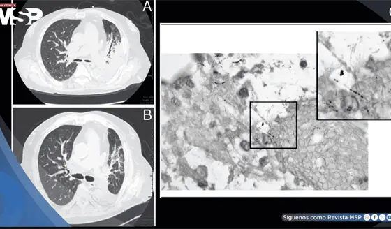 Detectan nocardiosis pulmonar como causa de neumon&iacute;a severa refractaria en paciente con EPOC