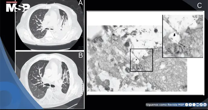 Detectan nocardiosis pulmonar como causa de neumonía severa refractaria en paciente con EPOC Detectan nocardiosis pulmonar como causa de neumonía severa refractaria en paciente con EPOC