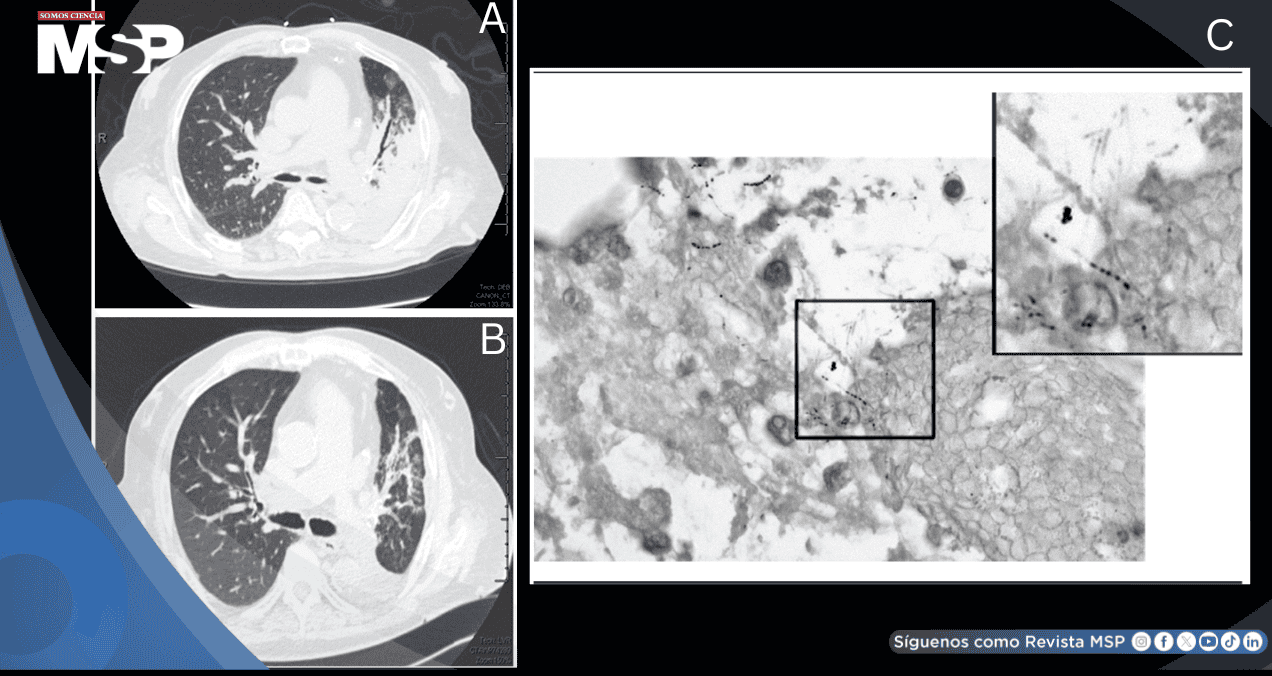 Detectan nocardiosis pulmonar como causa de neumonía severa refractaria en paciente con EPOC
