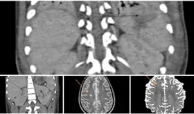 Síndrome inflamatorio multisistémico pos-COVID-19 en adolescente con miocardiopatía y lesión renal