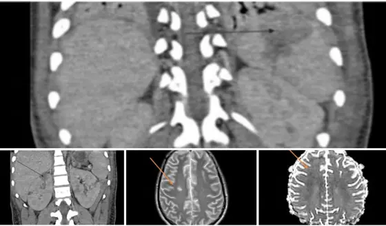 S&iacute;ndrome inflamatorio multisist&eacute;mico pos-COVID-19 en adolescente con miocardiopat&iacute;a y lesi&oacute;n renal