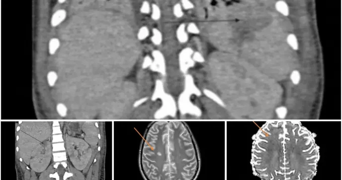 Síndrome inflamatorio multisistémico pos-COVID-19 en adolescente con miocardiopatía y lesión renal Síndrome inflamatorio multisistémico pos-COVID-19 en adolescente con miocardiopatía y lesión renal