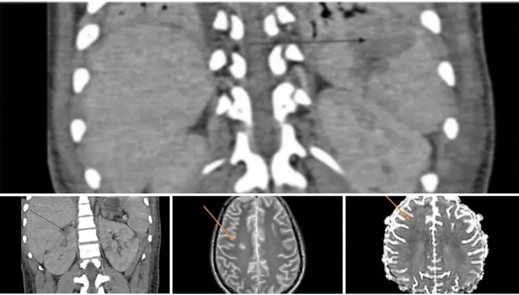 Síndrome inflamatorio multisistémico pos-COVID-19 en adolescente con miocardiopatía y lesión renal Síndrome inflamatorio multisistémico pos-COVID-19 en adolescente con miocardiopatía y lesión renal