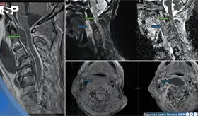 Infecci&oacute;n oral avanza a absceso cervical con compromiso epidural y shock s&eacute;ptico en adulto mayor