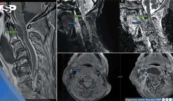 Infecci&oacute;n oral avanza a absceso cervical con compromiso epidural y shock s&eacute;ptico en adulto mayor
