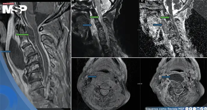 Infecci&oacute;n oral avanza a absceso cervical con compromiso epidural y shock s&eacute;ptico en adulto mayor