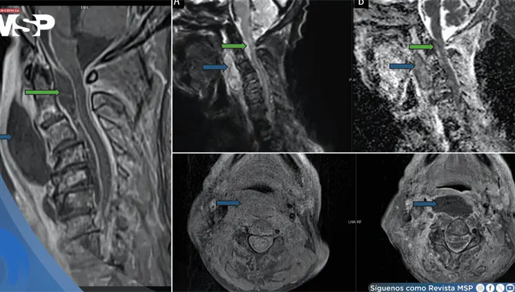 Infecci&oacute;n oral avanza a absceso cervical con compromiso epidural y shock s&eacute;ptico en adulto mayor