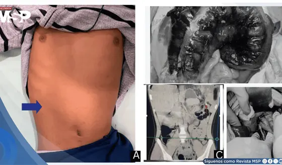 Detectan hernia diafragm&aacute;tica que ocasionaba obstrucci&oacute;n intestinal en paciente de 18 a&ntilde;os
