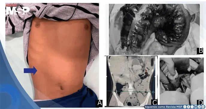 Detectan hernia diafragmática que ocasionaba obstrucción intestinal en paciente de 18 años Detectan hernia diafragmática que ocasionaba obstrucción intestinal en paciente de 18 años