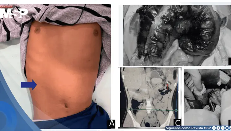 Detectan hernia diafragmática que ocasionaba obstrucción intestinal en paciente de 18 años Detectan hernia diafragmática que ocasionaba obstrucción intestinal en paciente de 18 años