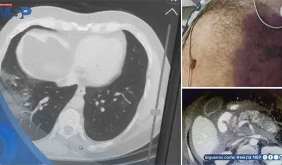 Pancreatitis necrosante como complicaci&oacute;n pos-COVID-19 en hombre con shock e insuficiencia multiorg&aacute;nica