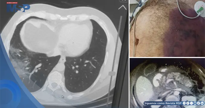Pancreatitis necrosante como complicaci&oacute;n pos-COVID-19 en hombre con shock e insuficiencia multiorg&aacute;nica