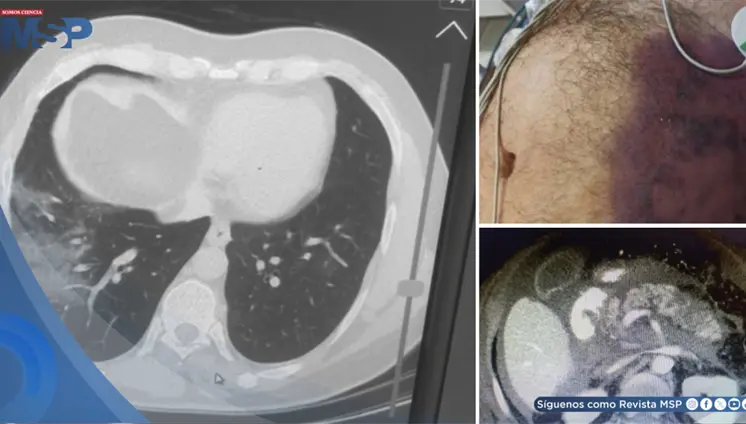 Pancreatitis necrosante como complicación pos-COVID-19 en hombre con shock e insuficiencia multiorgánica Pancreatitis necrosante como complicación pos-COVID-19 en hombre con shock e insuficiencia multiorgánica