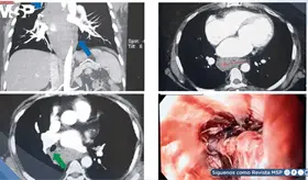 Hematoma esof&aacute;gico intramural imit&oacute; un s&iacute;ndrome coronario agudo en paciente anticoagulada