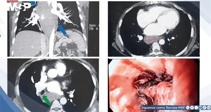 Hematoma esof&aacute;gico intramural imit&oacute; un s&iacute;ndrome coronario agudo en paciente anticoagulada