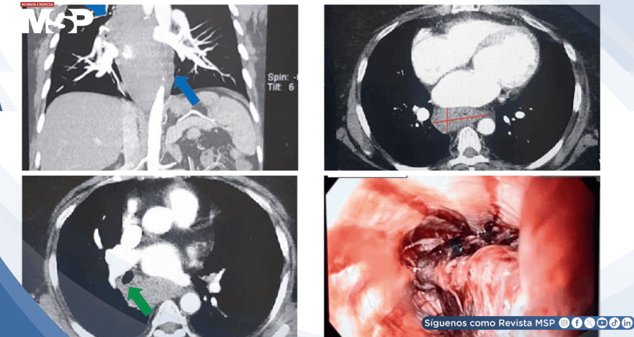 Hematoma esofágico intramural imitó un síndrome coronario agudo en paciente anticoagulada Hematoma esofágico intramural imitó un síndrome coronario agudo en paciente anticoagulada