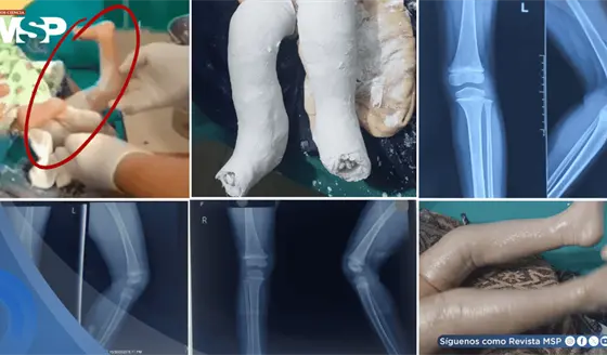 Reci&eacute;n nacida con luxaci&oacute;n de ambas rodillas e hiperextensi&oacute;n casi a 100&deg;: Correcci&oacute;n no quir&uacute;rgica