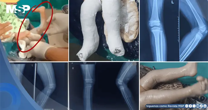 Reci&eacute;n nacida con luxaci&oacute;n de ambas rodillas e hiperextensi&oacute;n casi a 100&deg;: Correcci&oacute;n no quir&uacute;rgica