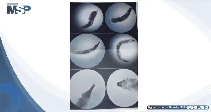 Diagn&oacute;stico tard&iacute;o de miasis urogenital provoca necrosis y compromiso vesicouretral