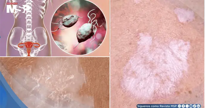 Ardor y prurito en la zona genital: As&iacute; se reconoce y trata el liquen escleroso