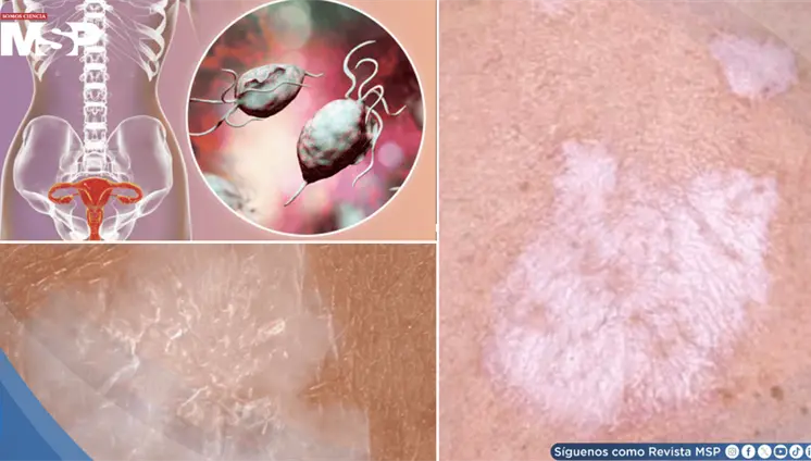 Ardor y prurito en la zona genital: Así se reconoce y trata el liquen escleroso Ardor y prurito en la zona genital: Así se reconoce y trata el liquen escleroso