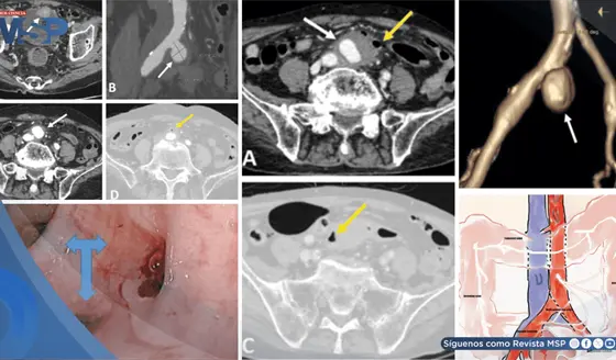 Sangrado intestinal como primer s&iacute;ntoma de aneurisma infectado que perfor&oacute; el colon de adulto mayor