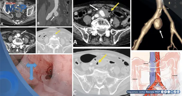 Sangrado intestinal como primer s&iacute;ntoma de aneurisma infectado que perfor&oacute; el colon de adulto mayor