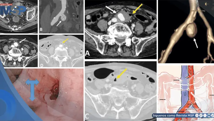 Sangrado intestinal como primer s&iacute;ntoma de aneurisma infectado que perfor&oacute; el colon de adulto mayor
