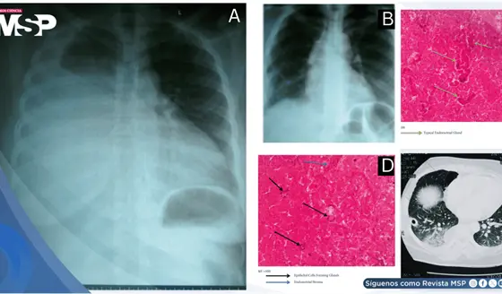 Hemot&oacute;rax catamenial por endometriosis tor&aacute;cica como causa de disnea y dolor tor&aacute;cico c&iacute;clico en paciente