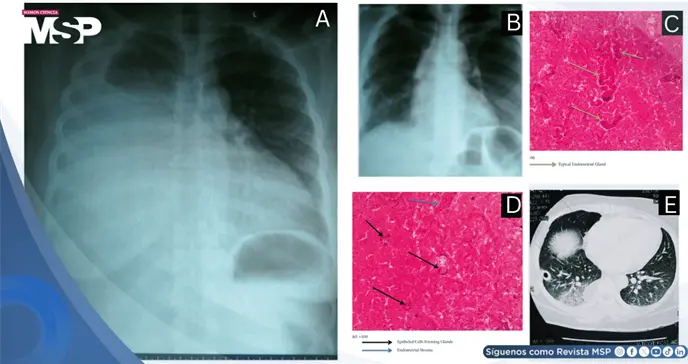 Hemot&oacute;rax catamenial por endometriosis tor&aacute;cica como causa de disnea y dolor tor&aacute;cico c&iacute;clico en paciente