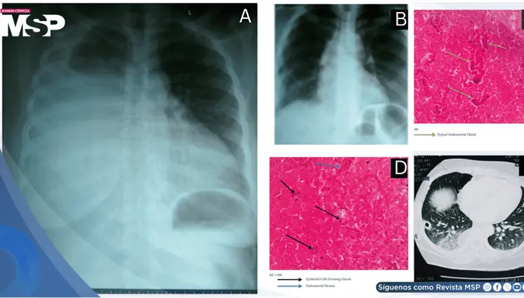Hemotórax catamenial por endometriosis torácica como causa de disnea y dolor torácico cíclico en paciente Hemotórax catamenial por endometriosis torácica como causa de disnea y dolor torácico cíclico en paciente