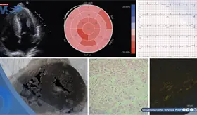 Amiloidosis card&iacute;aca asociada a mieloma m&uacute;ltiple provoca arritmia ventricular fatal en mujer de 71 a&ntilde;os