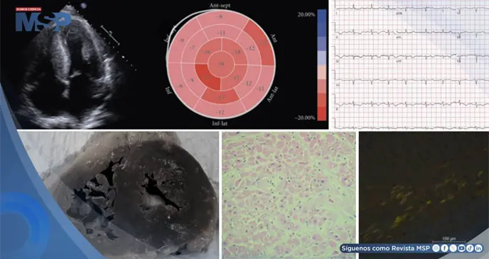 Amiloidosis card&iacute;aca asociada a mieloma m&uacute;ltiple provoca arritmia ventricular fatal en mujer de 71 a&ntilde;os