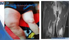 Identifican infarto muscular diab&eacute;tico en paciente con masa dolorosa en muslo y diabetes no controlada