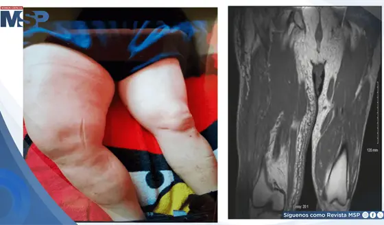 Identifican infarto muscular diab&eacute;tico en paciente con masa dolorosa en muslo y diabetes no controlada