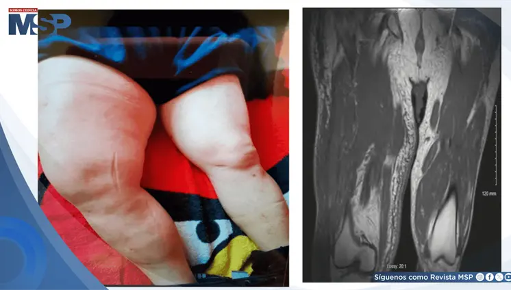 Identifican infarto muscular diabético en paciente con masa dolorosa en muslo y diabetes no controlada Identifican infarto muscular diabético en paciente con masa dolorosa en muslo y diabetes no controlada