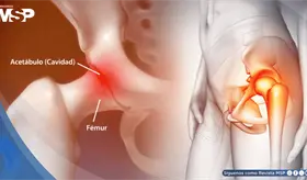 &iquest;Dolor en la cadera? Estas son sus causas, tratamientos y cu&aacute;ndo deber&iacute;a consultar al m&eacute;dico