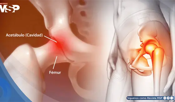 &iquest;Dolor en la cadera? Estas son sus causas, tratamientos y cu&aacute;ndo deber&iacute;a consultar al m&eacute;dico